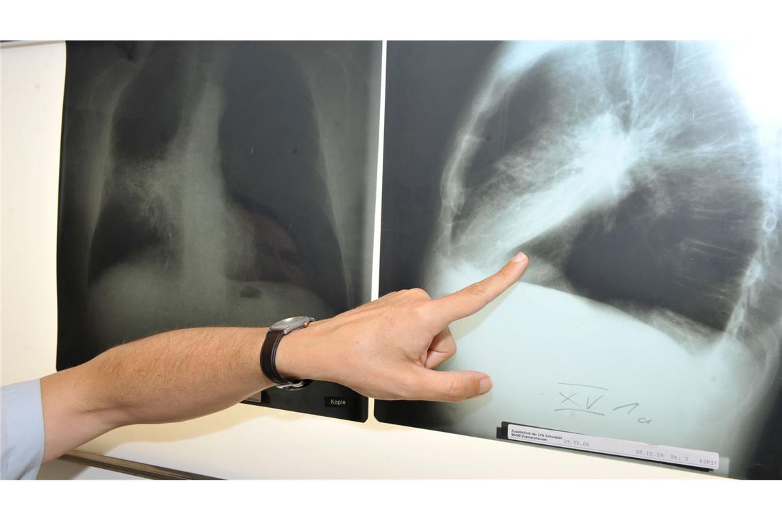 Ab April soll es losgehen mit dem neuen Programm zur Früherkennung von Lungenkrebs.