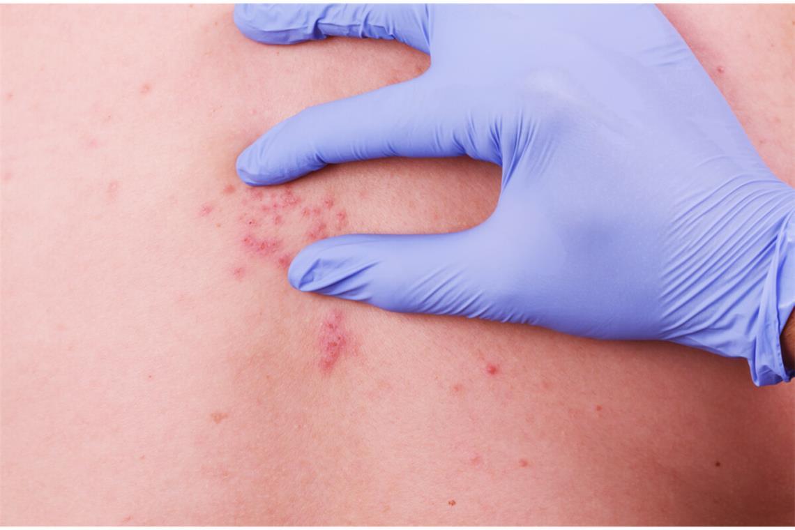 Als Folgeerkrankung von Windpocken kann die Gürtelrose schmerzhaft sein. Was Sie nicht machen sollten, erfahren Sie hier.