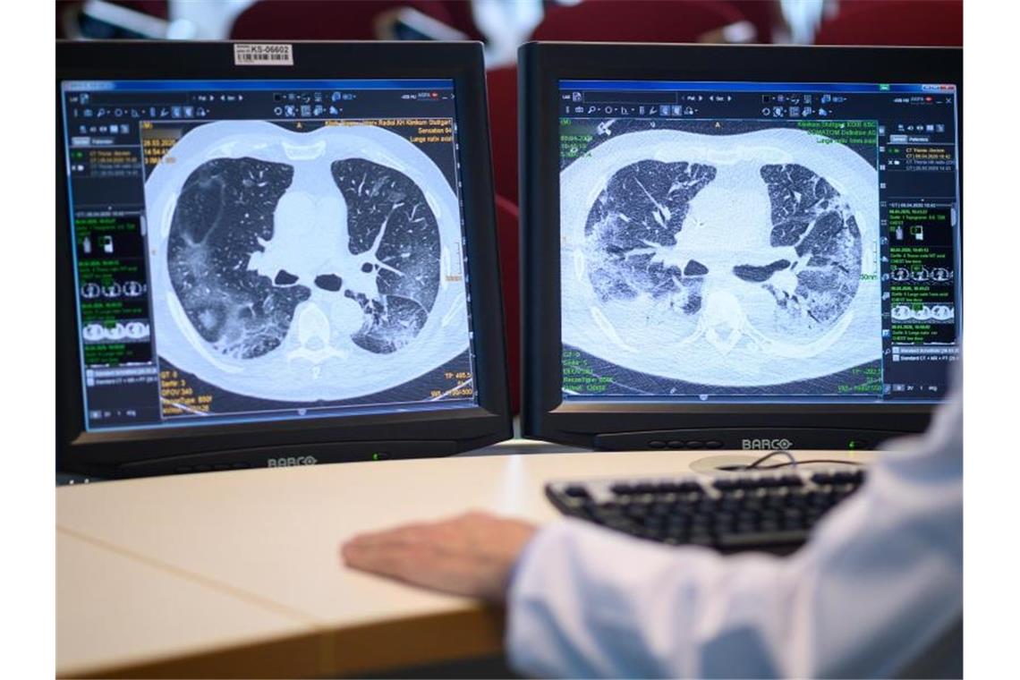 Auf zwei Monitoren sind am Klinikum Stuttgart Computertomographieaufnahmen der Lunge eines Covid-19-Patienten zu sehen. Foto: Sebastian Gollnow/dpa
