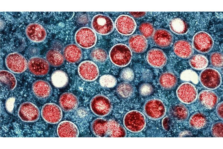 Beim Menschen wurden Mpox erstmals 1970 in der Demokratischen Republik Kongo identifiziert (Symbolbild).