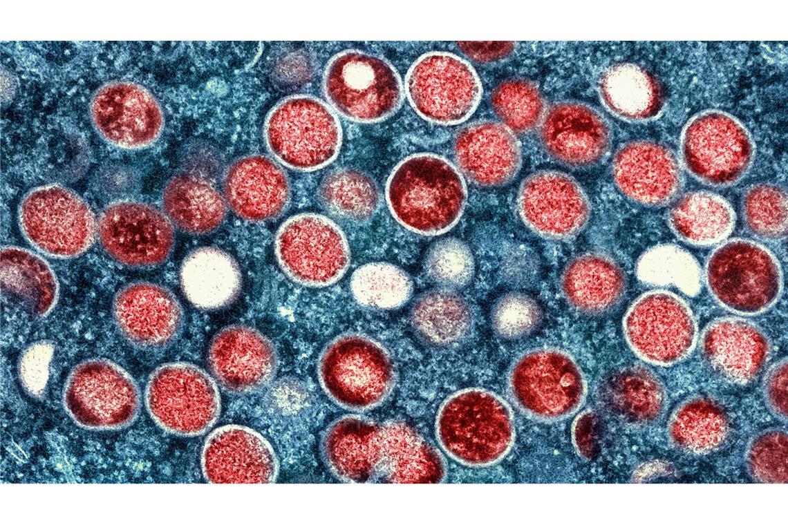 Mehr Fälle von Mpox – aber Experte bislang gelassen Bislang sieht das Robert-Koch-Institut keine Anzeichen zur Besorgnis.