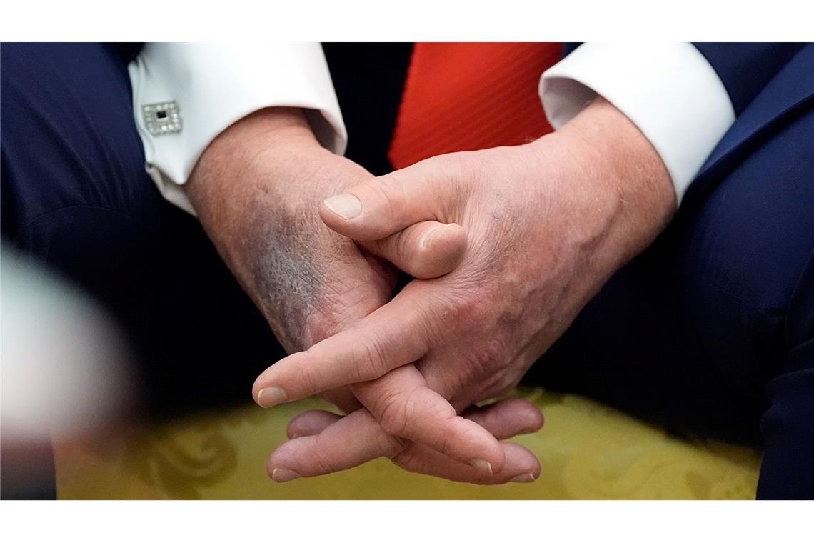 Blaue Flecken geben immer wieder Anlass für Spekulationen. (Archivbild)