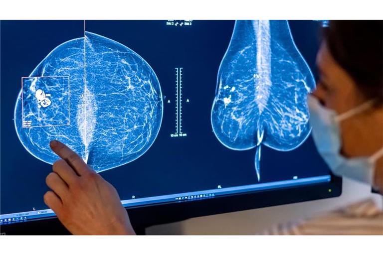 Brustkrebs ist die häufigste Krebserkrankung bei Frauen.