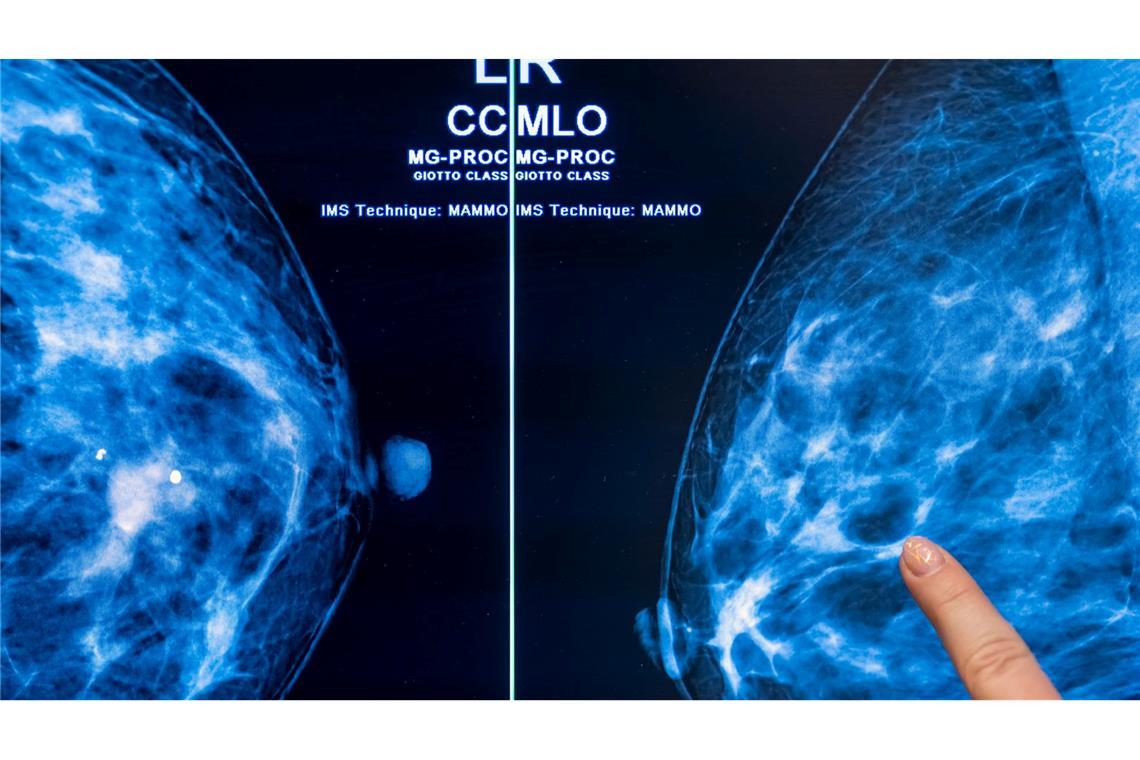 Mammografie-Screening senkt Brustkrebs-Sterblichkeit Brustkrebs stellt mit etwa 75.000 Neuerkrankungen jährlich die häufigste Krebserkrankung bei Frauen in Deutschland dar. (Archivbild)