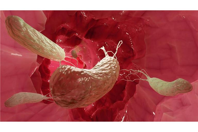 Das Magenbakterium Helicobacter pylori kann Magengeschwüre und Krebs verursachen.