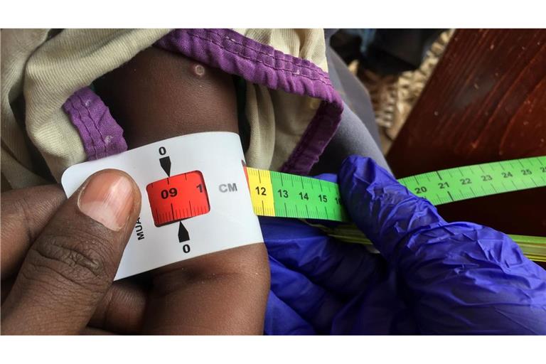 Der Armumfang eines schwer unterernährten Babys in Somalia wird gemessen. (Archivbild)