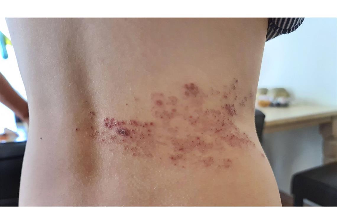 Gürtelrose: Erkrankung, Folgen, Therapie Die Gürtelrose ist eine Nervenerkrankung und wird durch das Varizella-Zoster-Virus ausgelöst – dasselbe Virus, das im Kindesalter Windpocken verursacht.