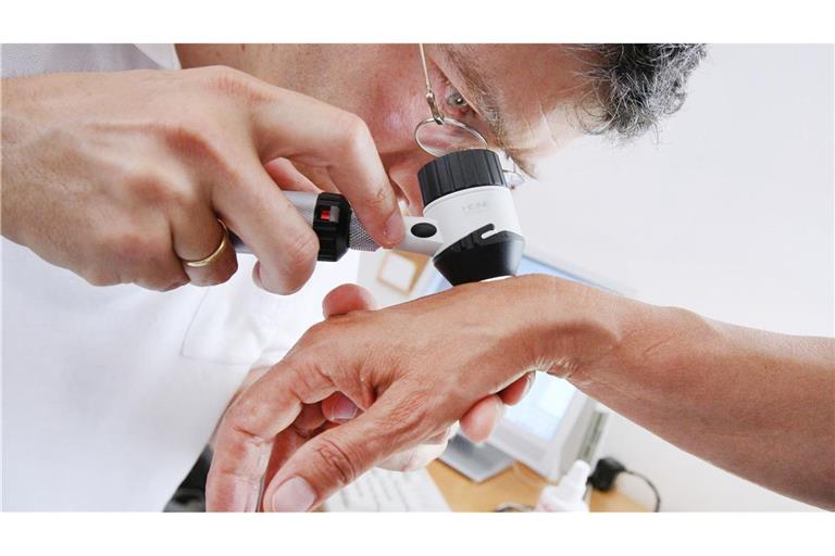 Die Zahl der Hautkrebs-Diagnosen ist in Baden-Württemberg deutlich gestiegen.
