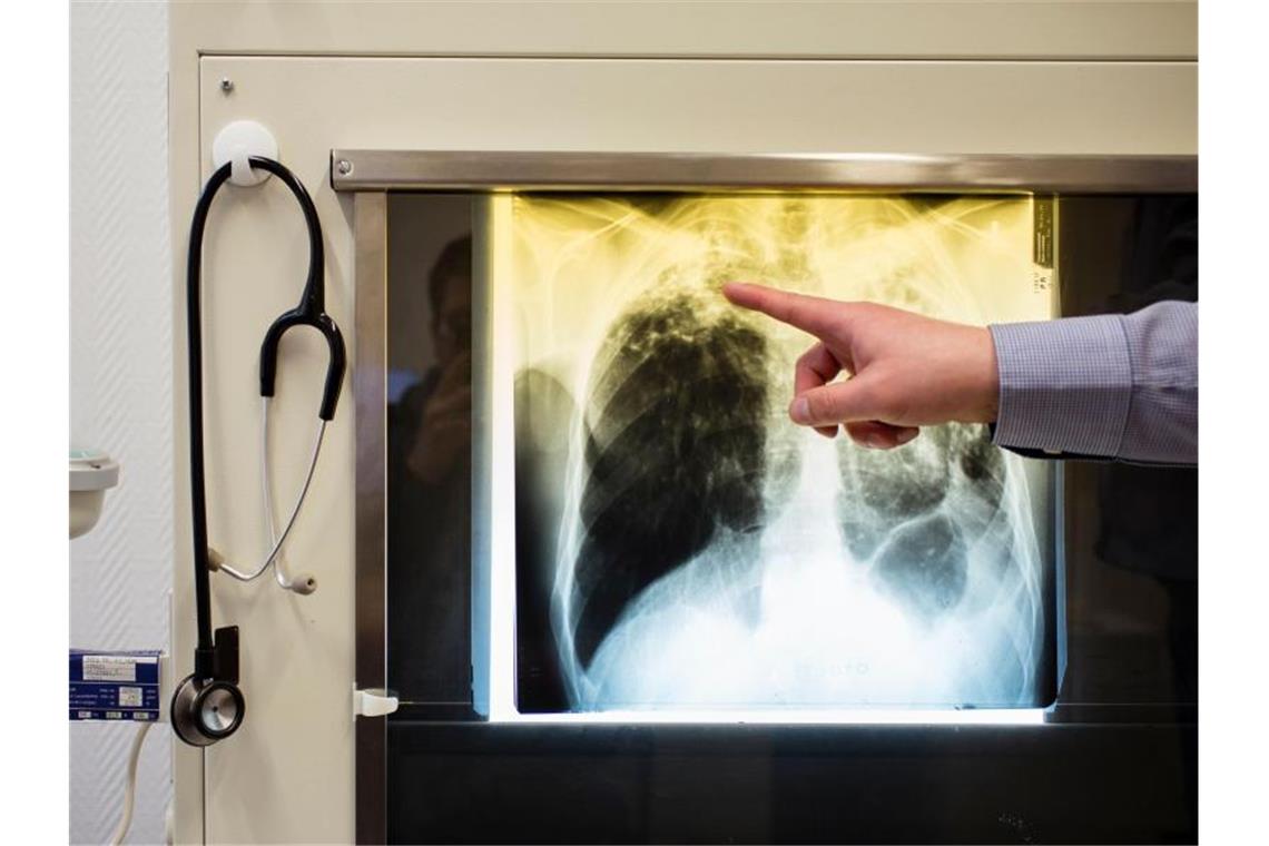 Ein Arzt zeigt auf das Röntgenbild eines Tuberkulose-Patienten. Foto: Gregor Fischer/Archivbild