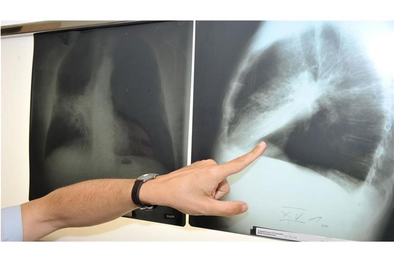 Ein Arzt zeigt auf ein Röntgenbild einer von Krebs befallenen Lunge.