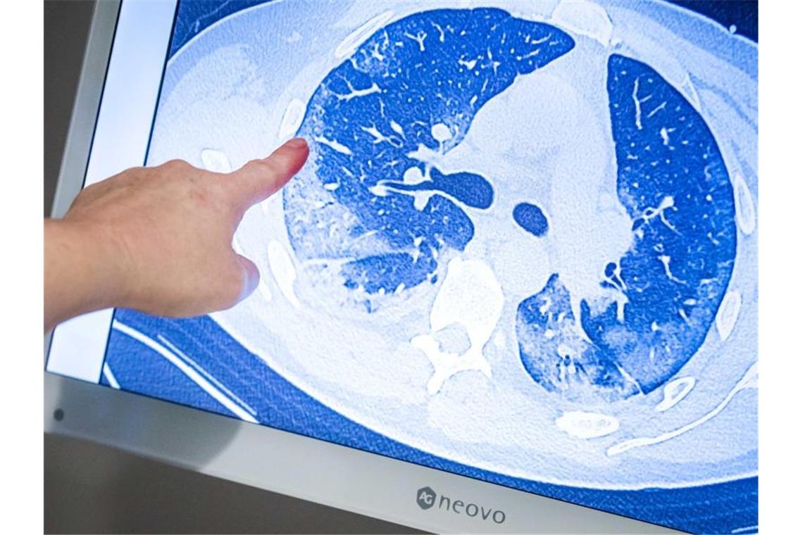 Ein behandelnder Arzt zeigt auf die CT-Aufnahme der Lunge eines Patienten, der sich mit dem Coronavirus infiziert hat. Foto: Remko De Waal/ANP/dpa
