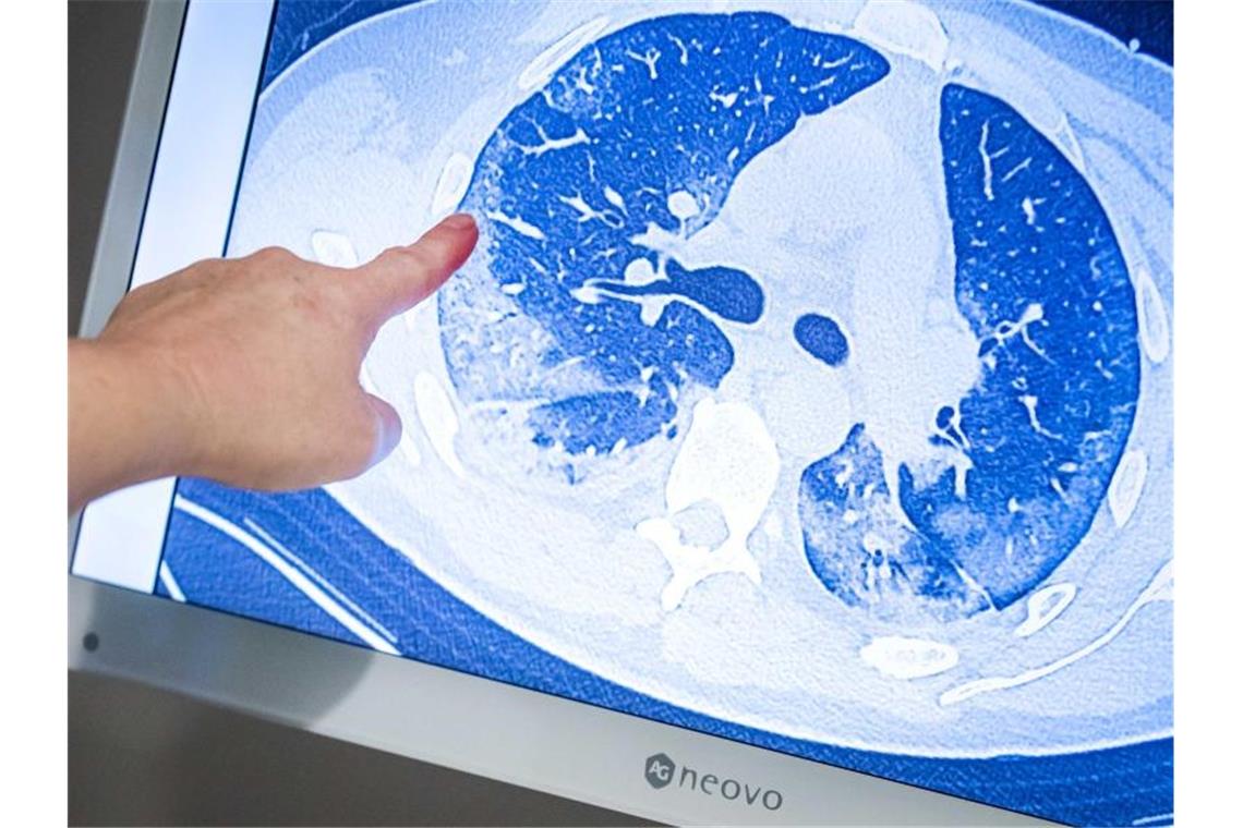 Covid-19-Spätfolgen wie vermindertes Lungenvolumen möglich
