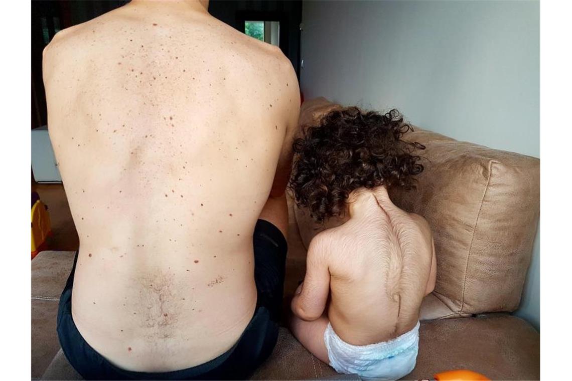 Medikament verwandelt Babys in Spanien in „Werwölfe“ Ein Mädchen mit dem vom sogenannten „Werwolf-Syndrom“ (r.). Ein Pharma-Unternehmen hat aufgrund eines internen Fehlers ein Medikament falsch gekennzeichnet und in Spanien auf den Markt gebracht. Foto: Defensor del Paciente