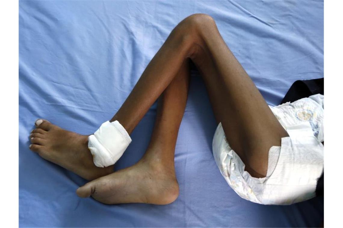 Welthungerhilfe: Corona „Brandbeschleuniger“ für Hunger Ein unterernährtes Kind liegt in einem Krankenhaus im jemenitischen Hudaida. Foto: Mohammed Mohammed/XinHua/dpa