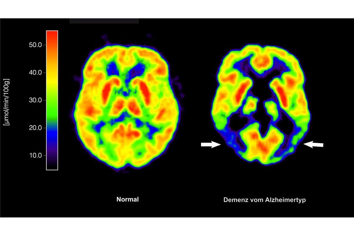 Entscheidung über Alzheimer-Therapie in EU verzögert sich Entscheidung über die Zulassung für Medikament zur Behandlung von Alzheimer-Patienten verzögert sich. (Archivbild)