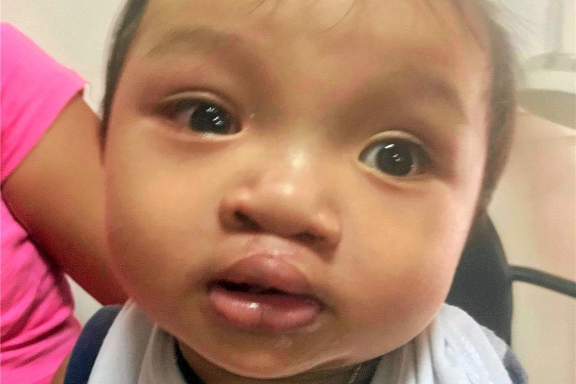 Fotodokumentation eines Kindes mit Gaumen-Lippen-Kieferspalte vor und nach der OP.