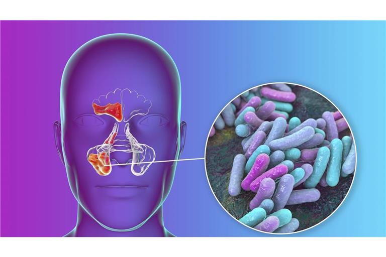 HIB steht für Haemophilus influenzae Typ b, ein Bakterium, das schwere Infektionen, insbesondere bei Kindern, verursachen kann. Zu den möglichen Erkrankungen gehören bakterielle Hirnhautentzündung (Meningitis) und Kehldeckelentzündung (Epiglottitis).