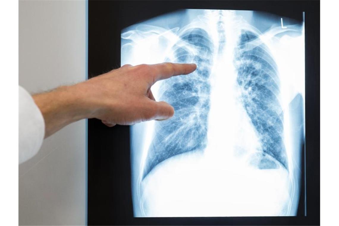 Tuberkulose: Gesundheitsminister Lucha schaltet sich ein
