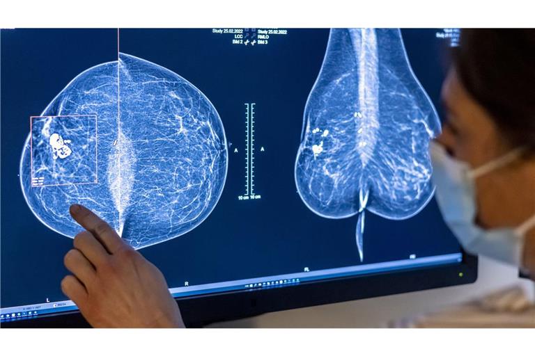 Medizinisches Personal untersucht mit einer Mammografie die Brust einer Frau auf Brustkrebs. Die Untersuchung soll bei der frühen Erkennung von Brustkrebs helfen.