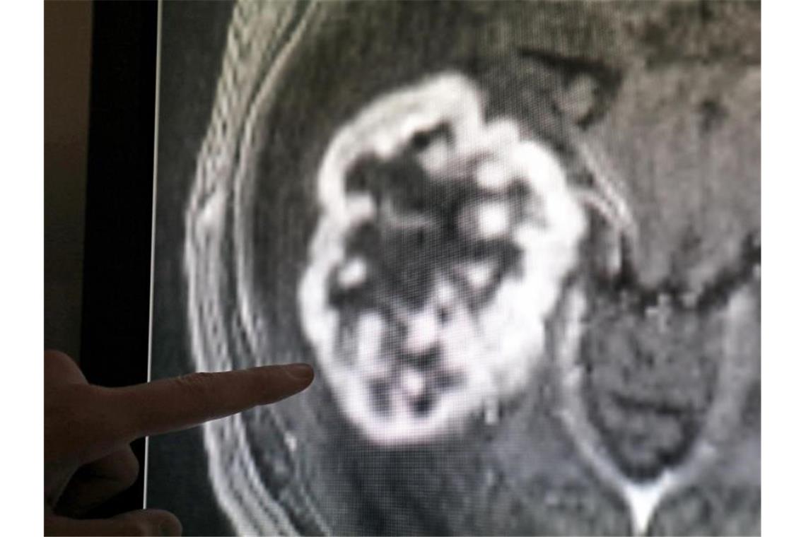 Mit Hilfe der Magnetresonanztomographie wird ein Tumor festgestellt. Foto: Bernd Wüstneck/dpa-Zentralbild/dpa