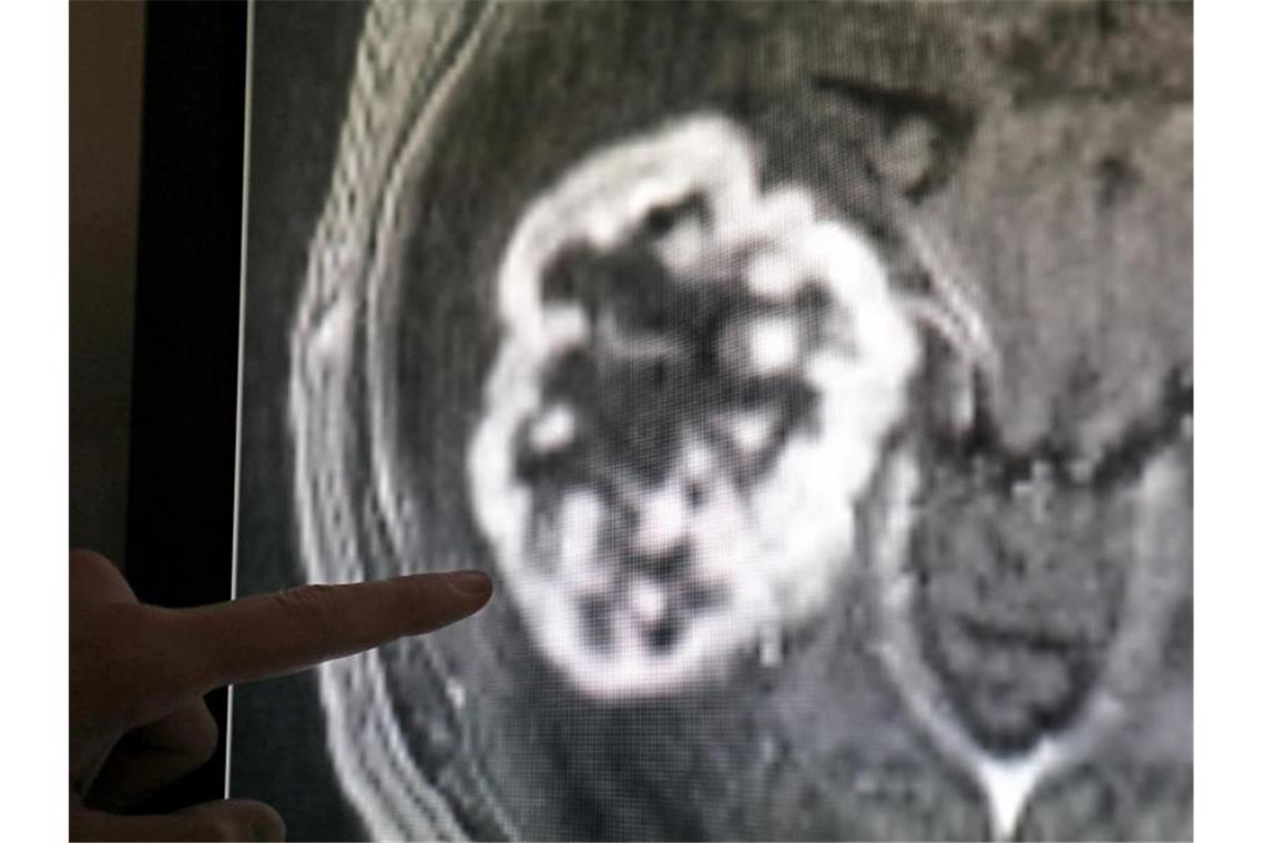 WHO warnt vor Verdoppelung der Krebserkrankungen bis 2040 Mit Hilfe der Magnetresonanztomographie wird ein Tumor festgestellt. Foto: Bernd Wüstneck/dpa-Zentralbild/dpa