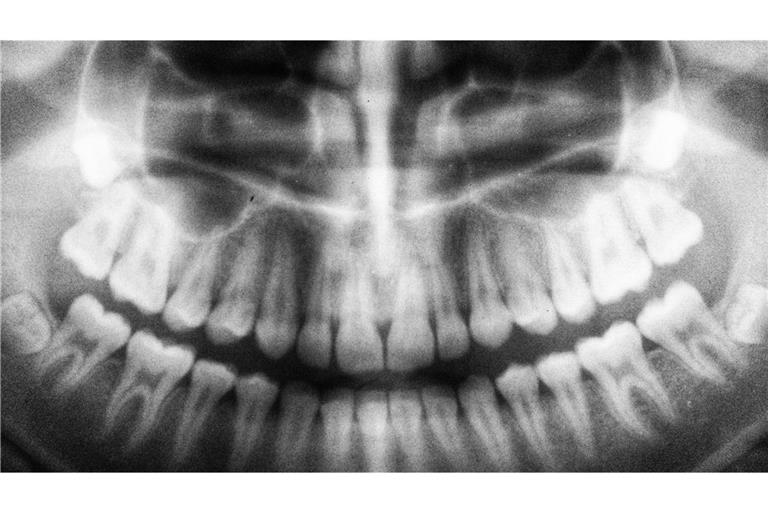 Muss es wirklich eine Weisheitszahn-OP sein?