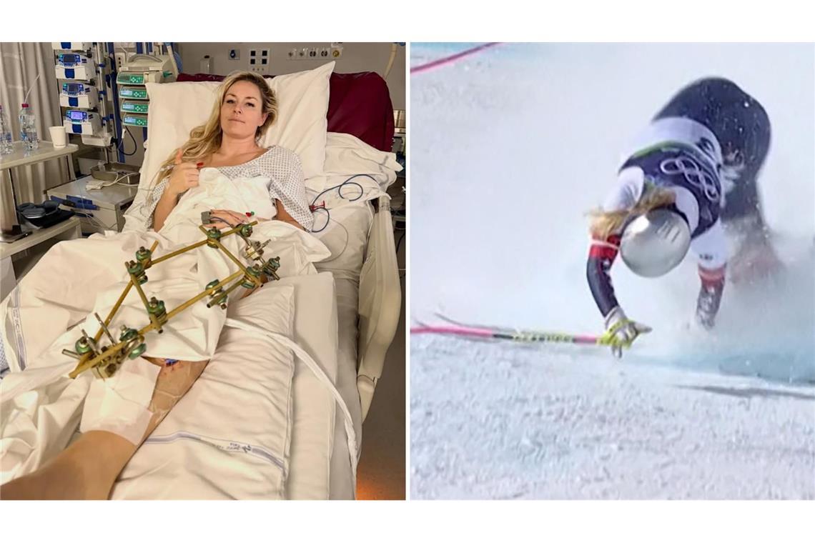 Nach ihrem Schienbeinbruch auf der Tofana liegt Lindsey Vonn mit einem „Fixateur externe“ in der Klinik.