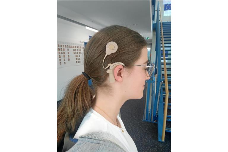 Nur der Soundprozessor und die Sendespule sind am Kopf von Amelie Grün erkennbar, das eigentliche Implantat befindet sich hinter dem Schädelknochen. Foto: Dietrich Hub