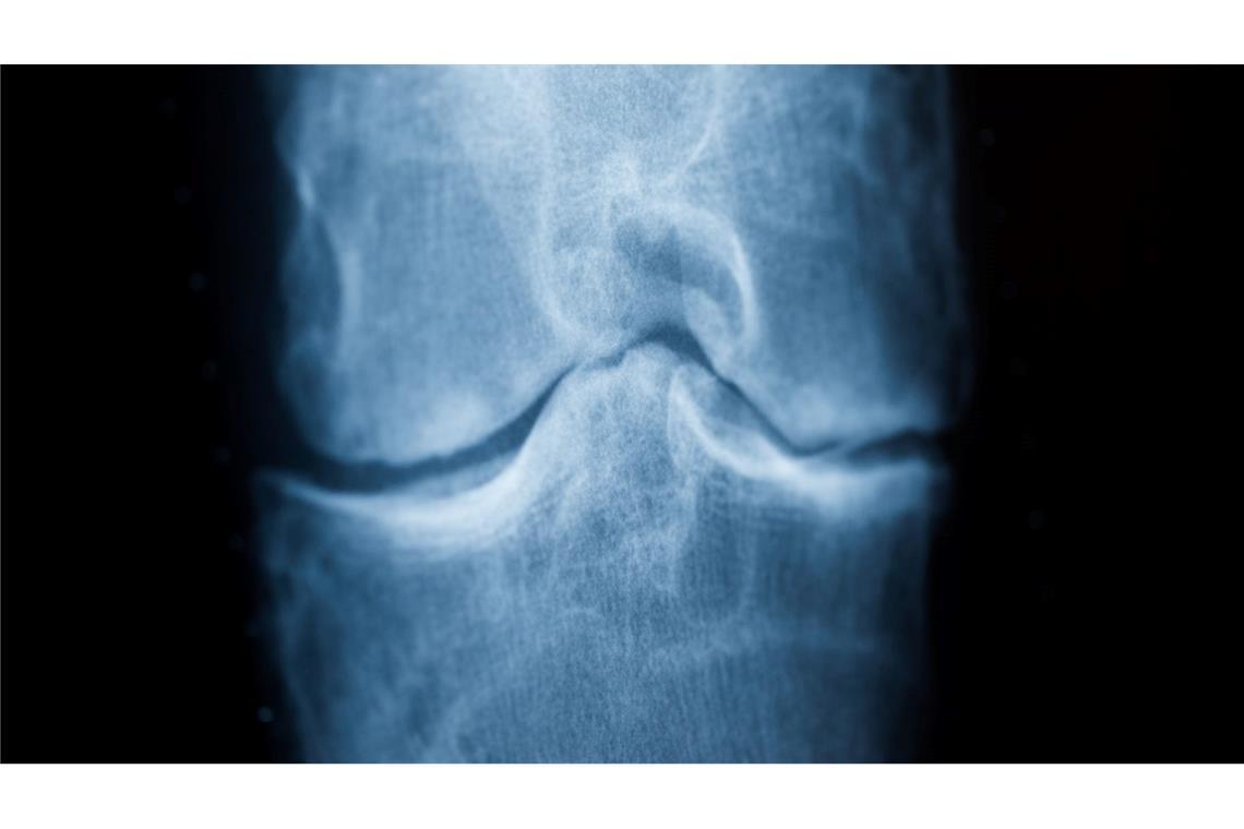 Anders gehen bei Knie-Arthrose könnte helfen Spätestens das Röntgenbild schafft Klarheit: Der Knorpel nutzt sich immer mehr ab. Im späteren Stadium einer Arthrose reibt Knochen direkt auf Knochen. (Archivbild)