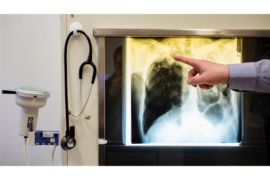 Tuberkulose-Erkrankungen werden in Europa oft nicht erkannt. (Illustration)