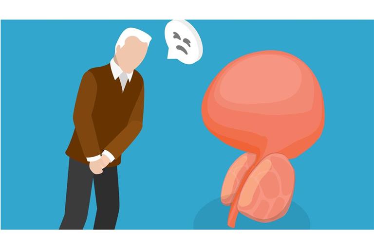 Viele merken zunächst nichts. Erst wenn der Harnstrahl schwächer wird oder der Urin rot ist, schöpft der Betroffene Verdacht. Beides kann Folge einer vergrößerte Prostata sein, eine ganz normale Alterserscheinung. Die Diagnose kann aber auch Prostatakrebs lauten – die häufigste Krebserkrankung beim Mann.