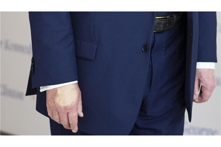 Wirklich nur vom vielen Händeschütteln? Auffällige Flecken auf Trumps Händen sorgen für Fragen.