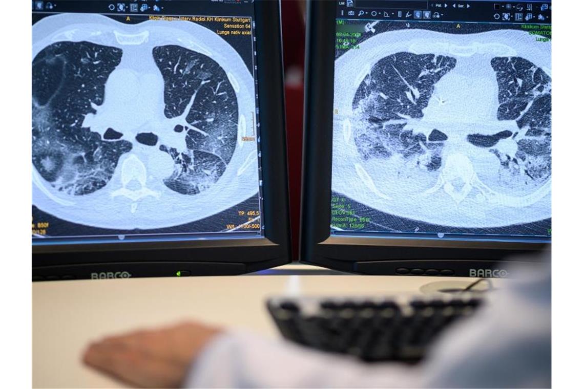 Zwei Monitore im Klinikum zeigen die Lunge eines Patienten. Foto: Sebastian Gollnow/dpa/Archivbild